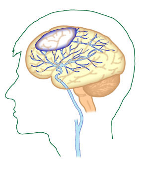 Tissue damage resulting from arterial aneurysm rupture (on the surface of the brain or within the brain