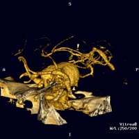 3-D CT reconstruction using Vitrea software of giant aneurysm in the posterior Communicating artery. Courtesy of Dr. Kieran Murphy, Johns Hopkins University, Department of Radiology