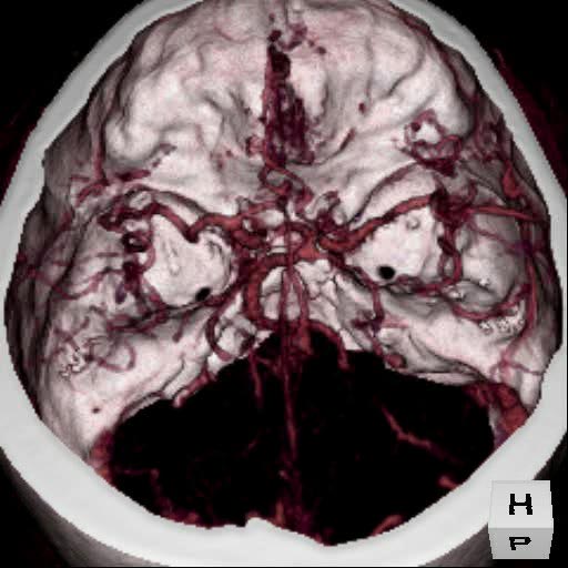 3-D Volumetric reconstruction of an anterior communicating artery aneurysm. Courtesy of Dr. Kieran Murphy, Johns Hopkins University, Department of Radiology