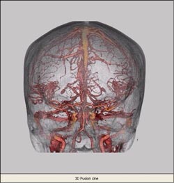 3-D CT reconstruction of intracranial arterial and venous anatomy. Courtesy of Dr. Kieran Murphy, Johns Hopkins University, Department of Radiology
