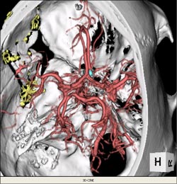 3-D reconstruction CT scan with aneurysm located in the paraopthalmic area. Courtesy of Dr. Kieran Murphy, Johns Hopkins University, Department of Radiology