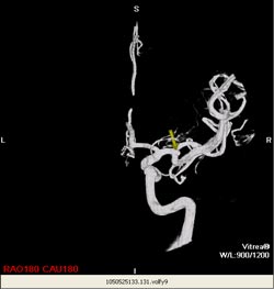 3-D CT scan reconstruction of small aneurysm at bifurcation of arteriole (arrow designates aneurysm). Courtesy of Dr. Kieran Murphy, Johns Hopkins University, Department of Radiology